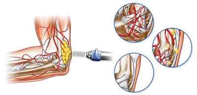 Ударно-хвильова терапія колінного і плечового суглоба, при грижі хребта: відгуки та лікування | Ревматолог