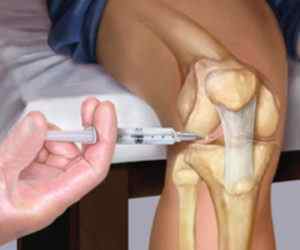Уколи дипроспана в плечовий і колінний суглоб: блокада суглоба, інструкція із застосування | Ревматолог