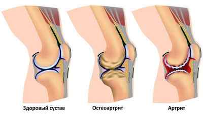 Уколи при артриті: при артриті і артрозі від запалення колінного суглоба, при ревматоїдному артриті | Ревматолог
