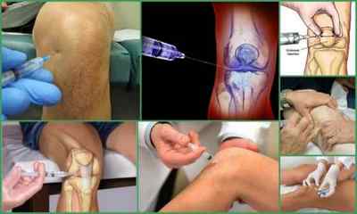 Уколи при артриті в суглоб і внутрішньомязово - лікування інєкціями