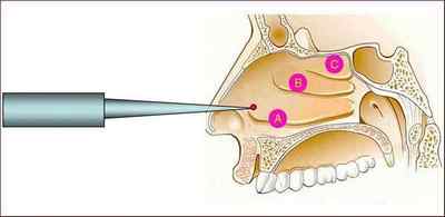 Ультразвукова дезінтеграція нижніх носових раковин: показання, проведення