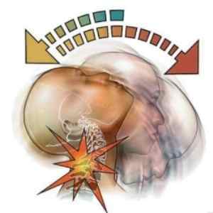Ункоартроз шийного відділу хребта: що це таке, симптоми і лікування | Ревматолог