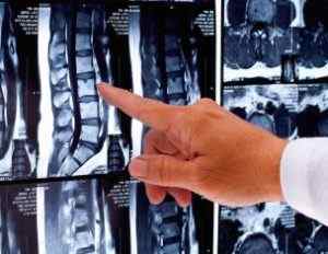 Унковертебральний артроз шийного відділу хребта: симптоми і лікування, що це таке | Ревматолог