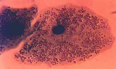 Ureaplasma parvum виявлено: що це може означати