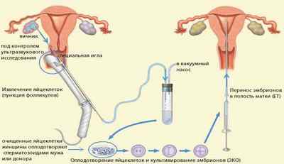 Уреаплазма парвум і ЕКО: вплив інфекції на плід