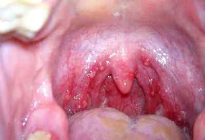 Уреаплазма в горлі: симптоми, лікування, ускладнення