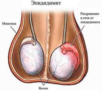 Уретрит у чоловіків: симптоми і лікування запалення сечовипускального каналу