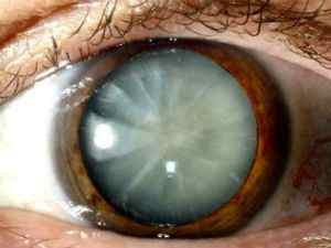 Ускладнена катаракта: що це таке, ускладнення, види (повна і неповна)