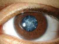 Ускладнена катаракта: що це таке, ускладнення, види (повна і неповна)
