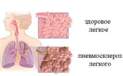Ускладнення бронхіальної астми при відсутності терапії