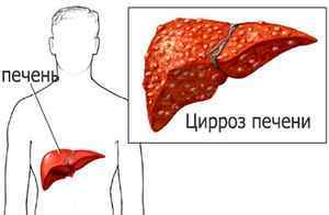 Ускладнення при цирозі печінки: анемія, кровотечі, розширення вен, стадії патології