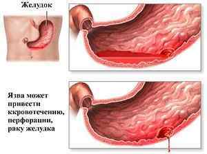 Ускладнення виразкової хвороби шлунка: класифікація, лікування та дієтотерапія