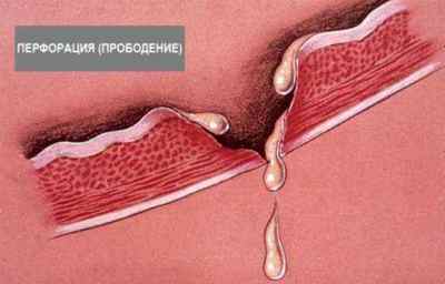 Ускладнення виразкової хвороби шлунка: класифікація, лікування та дієтотерапія