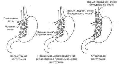 Ваготомія шлунка: показання, види, проведення і техніка, ускладнення