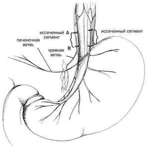 Ваготомія шлунка: показання, види, проведення і техніка, ускладнення