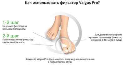 Valgus Pro: відгуки на гелевий фіксатор для великого пальця ноги, силіконовий фіксатор кісточки на великому пальці | Ревматолог
