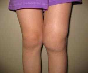 Вальгусна деформація колінних суглобів у дітей і дорослих: лікування та фото | Ревматолог