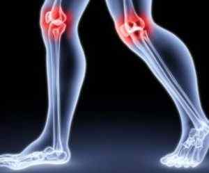 Вальгусна деформація колінних суглобів у дітей і дорослих: лікування та фото | Ревматолог