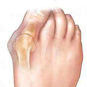 Вальгусна деформація стопи: ортопедичне взуття для дітей, лікування халюс вальгус великого пальця стопи у дорослих, операція | Ревматолог