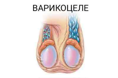 Варикоцеле у підлітків: причини, В симптоми і лікування