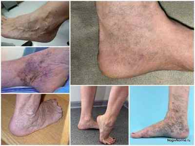 Варикоз на ступнях: фото, симптоми, лікування