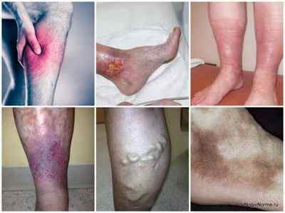 Варикоз у чоловіків на ногах: причини, симптоми, лікування, профілактика