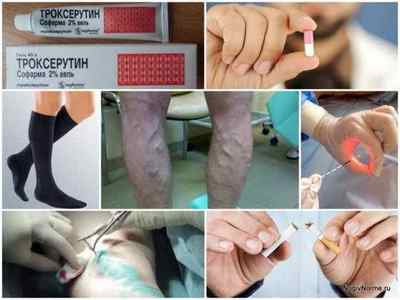Варикоз у чоловіків на ногах: причини, симптоми, лікування, профілактика