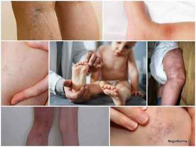 Варикоз у дітей на ногах: фото і лікування