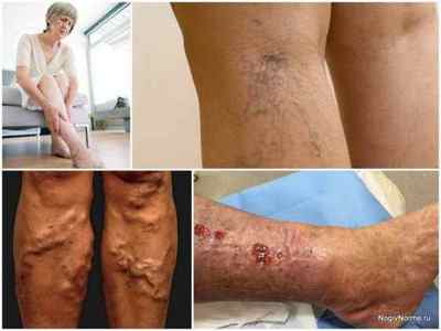 Варикоз вен на ногах: причини, симптоми, лікування, профілактика
