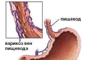 Варикозне розширення вен стравоходу 123 ступеня (ВРВ стравоходу): класифікація, ознаки, що це за хвороба