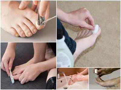 Вартнер Нейл Експерт від грибка нігтів: інструкція із застосування, ціна, відгуки