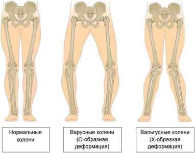 Варусна деформація гомілок: лікування вальгусной деформації нижніх кінцівок у дітей, варусне викривлення | Ревматолог