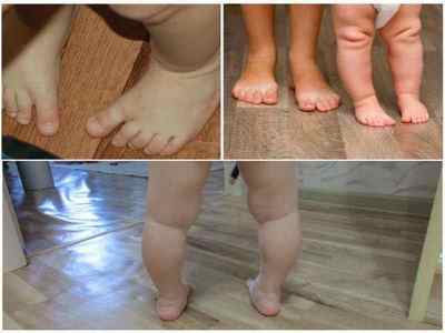 Варусна деформація стоп: лікування варусной установки нижніх кінцівок у дітей і дорослих, взуття та масаж, варусная пята | Ревматолог