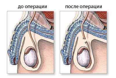 Вазектомія: суть операції, плюси і мінуси, життя після