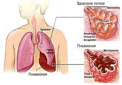 Важка пневмонія: причини розвитку, лікування
