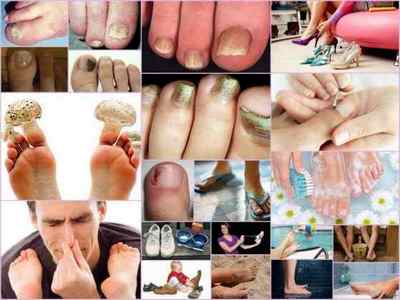 Від чого зявляється грибок на нігтях ніг