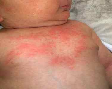 Відмінності пітниці від алергії у немовляти