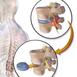 Відновлення міжхребцевих дисків: як відновити хребет, чи можна відновити без операції народними засобами | Ревматолог