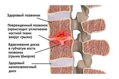 Відновлення міжхребцевих дисків: як відновити хребет, чи можна відновити без операції народними засобами | Ревматолог