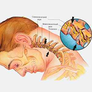 Вдовою горб: причини виникнення жировика на хребті, що таке ліпома хребта, горб на шиї | Ревматолог