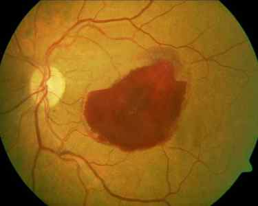 Відшарування скловидного тіла ока: лікування, симптоми, причини відшарування
