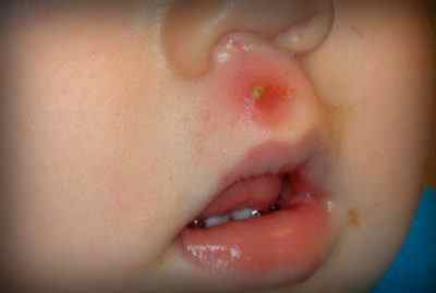 Великий гнійник або фурункул у дитини: лікування в домашніх умовах і хірургічне видалення