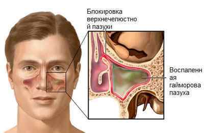 Верхньощелепної синусит (хронічний і гострий): симптоми, лікування