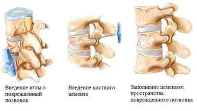 Вертебропластика хребта (цементування): відгуки після операції і реабілітація, що таке | Ревматолог