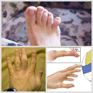 Вибитий палець на руці: як лікувати казанок, що робити якщо вибитий великий палець, симптоми, як вправити мізинець, як зрозуміти, що вибитий | Ревматолог
