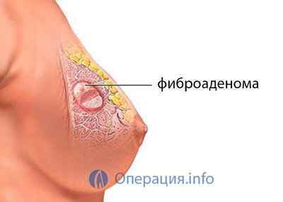 Видалення фіброаденоми молочної залози: операція і показання до неї, реабілітація