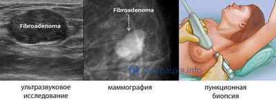 Видалення фіброаденоми молочної залози: операція і показання до неї, реабілітація