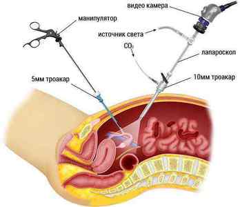 Видалення кісти яєчника: види операцій, показання