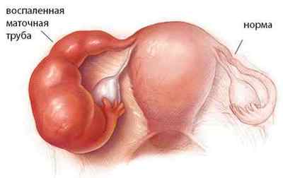 Видалення маткової труби (тубектомія): операція, показання, наслідки