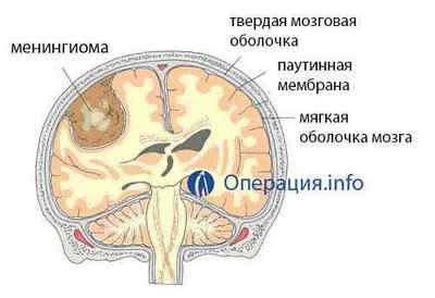 Видалення менінгіоми головного мозку (операція)